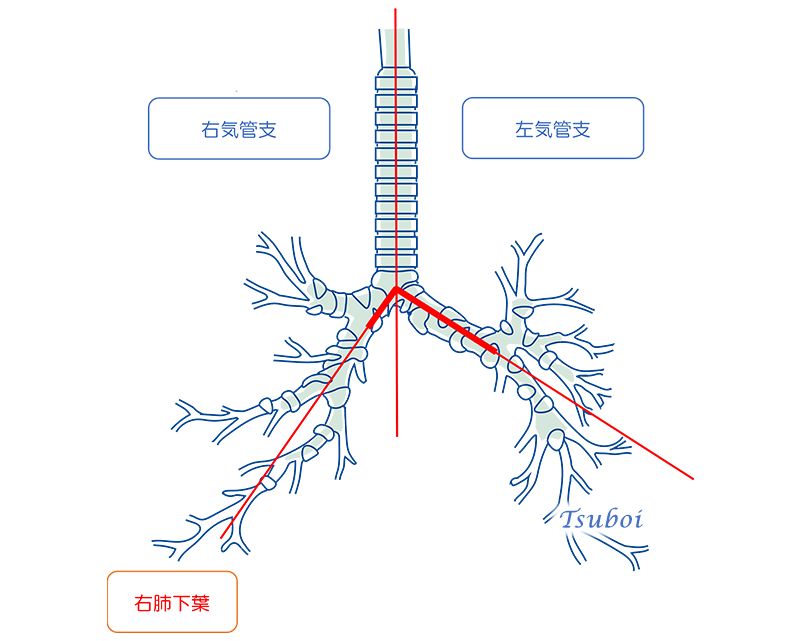 誤嚥性肺炎