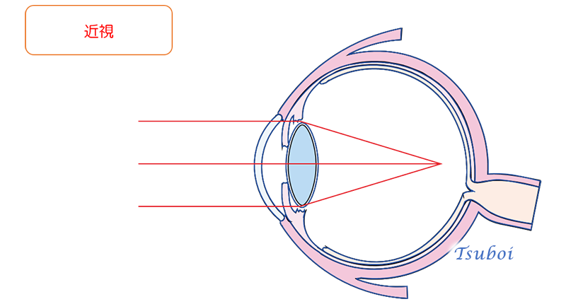 近視と遠視