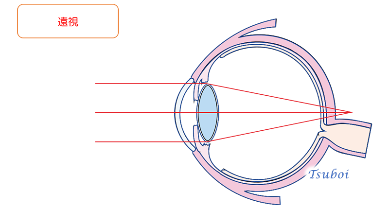 近視と遠視