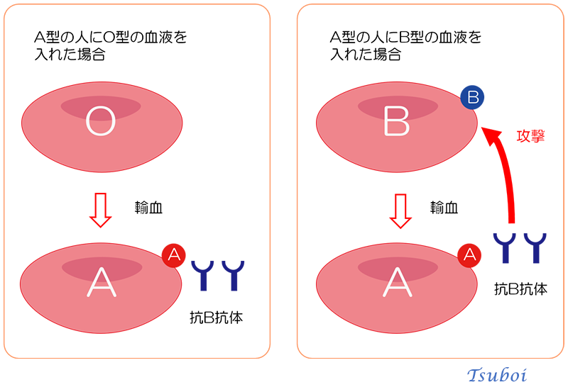 異型輸血（異なる血液型の輸血）