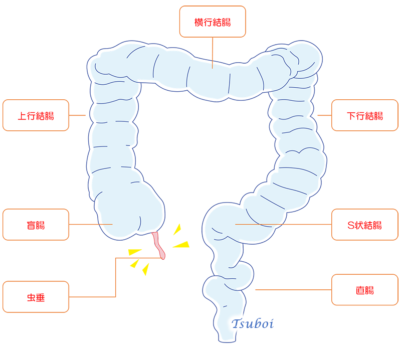 盲腸と虫垂炎