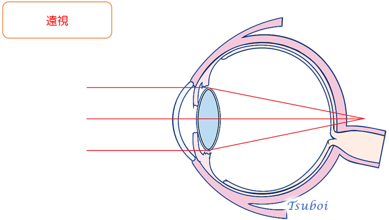 近視と遠視