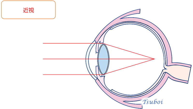 近視と遠視