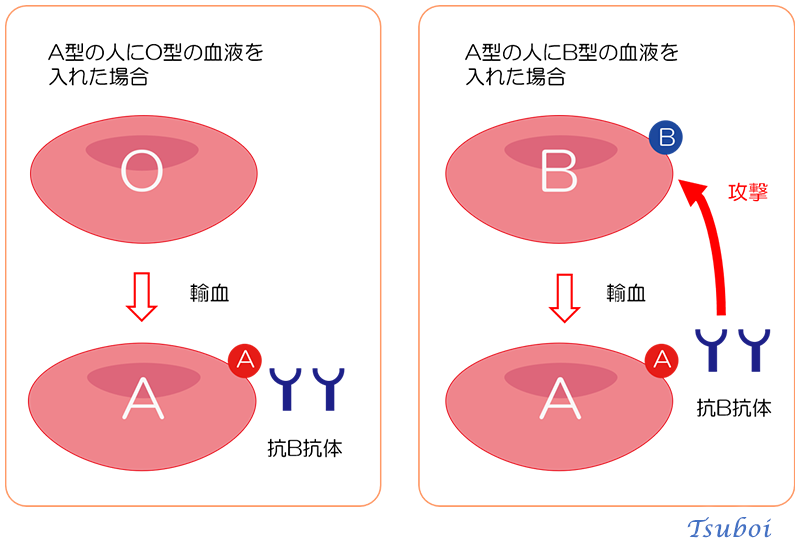 異型輸血（異なる血液型の輸血）