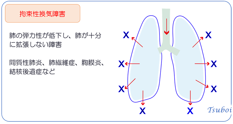 換気障害の分類