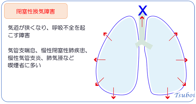 換気障害の分類