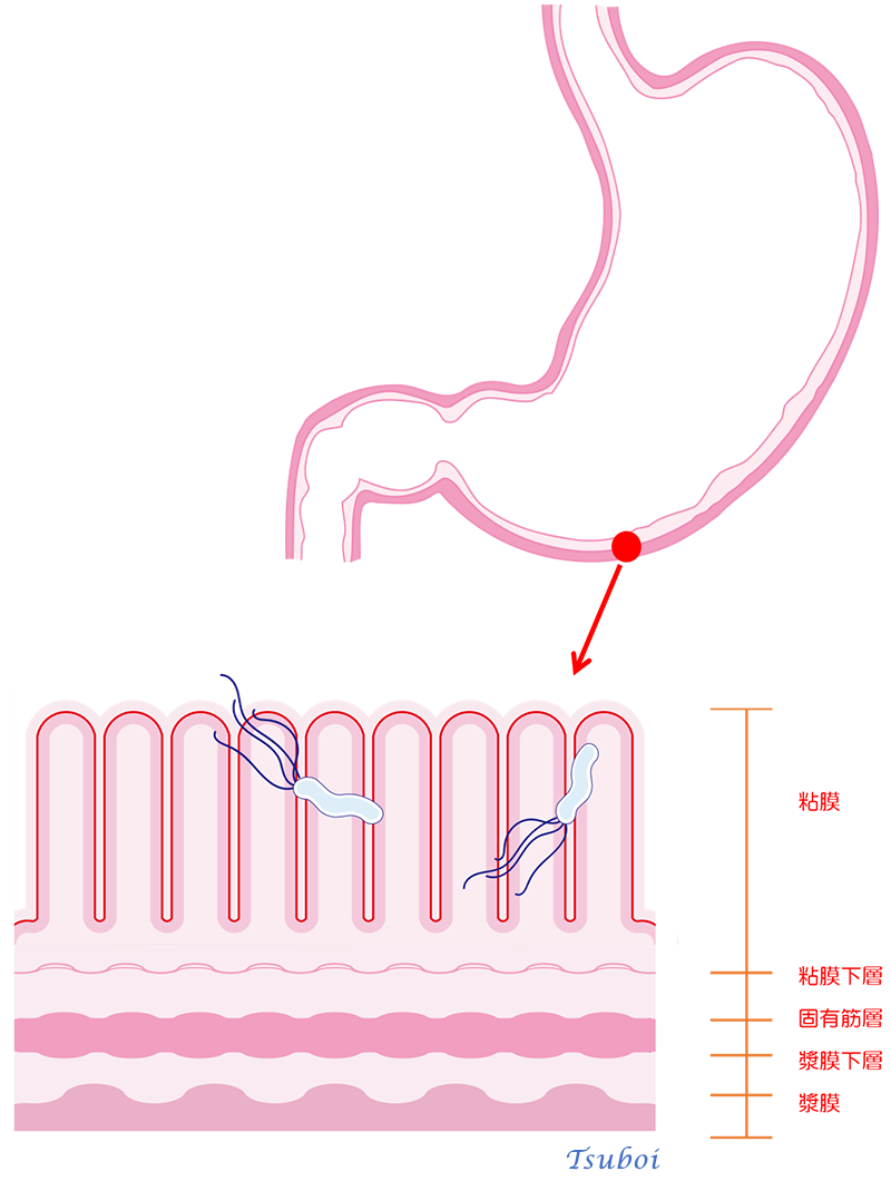 ピロリ菌