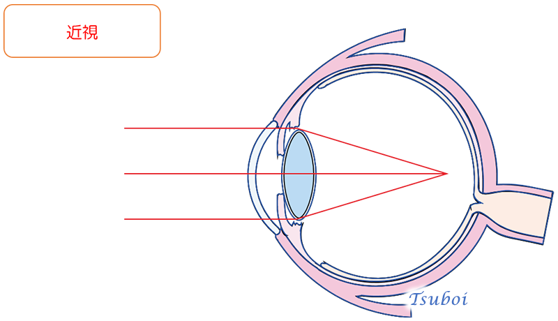 近視と遠視