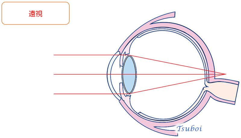 近視と遠視
