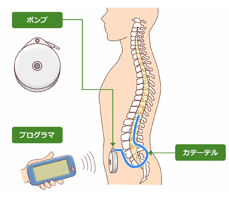 バクロフェン髄注療法