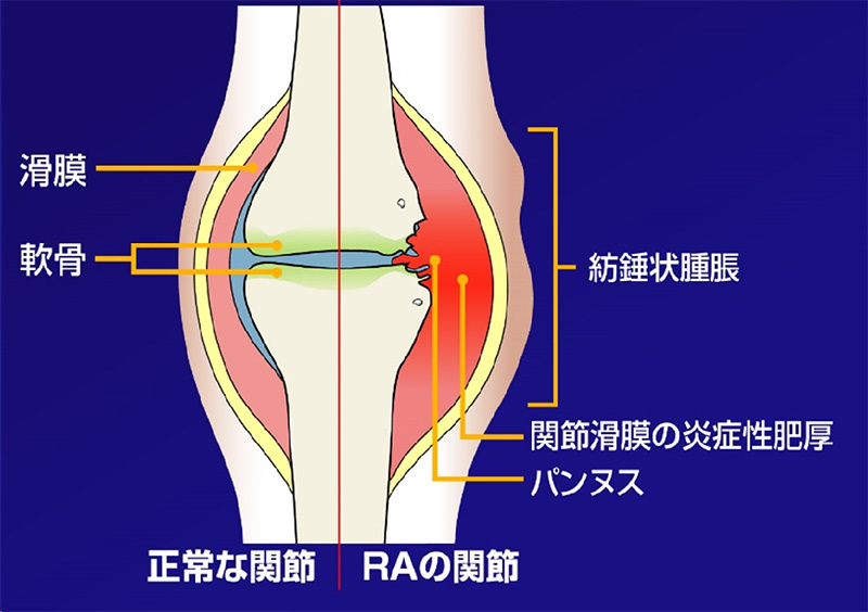 正常な関節と関節リウマチの関節を比較した模式図