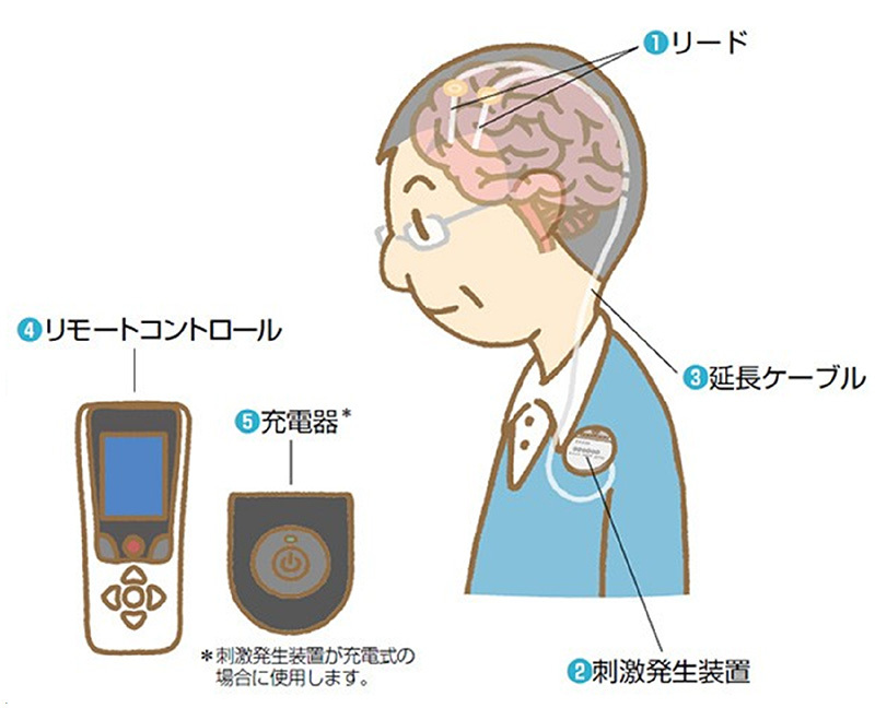 脳深部刺激療法（DBS）は普及しているとは言い難い治療方法です。